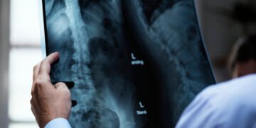 Unijorge oferece atendimento gratuito para avaliação e acompanhamento de pacientes com escoliose em Salvador