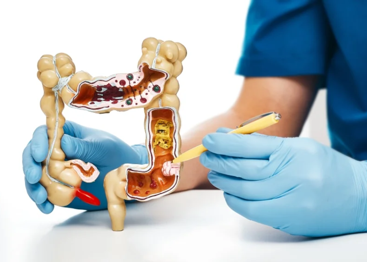 Anvisa aprova novo medicamento para pacientes com câncer colorretal metastático